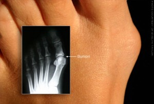 flickr_photo_of_bunion_and_xray